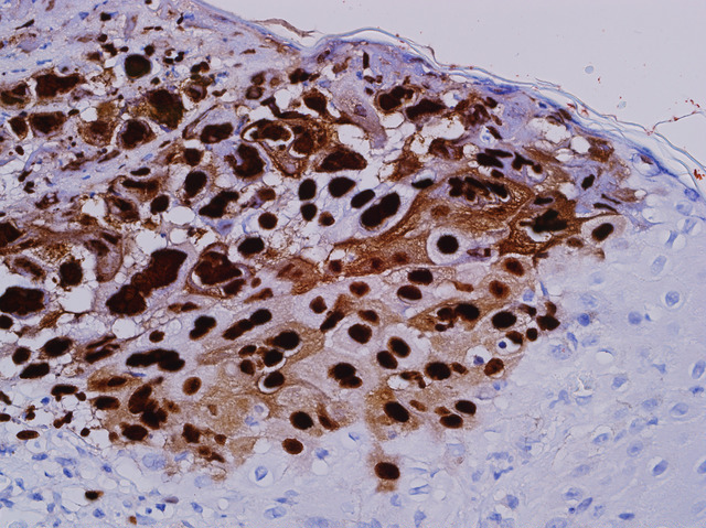 Герпесная инфекция в клетках. (Фото Michael Patterson / www.flickr.com/photos/122871994@N05/13760402585.)