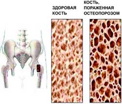Борьба с остеопорозом продолжается - новая форма витамина D.