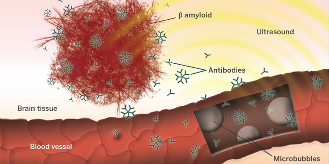 Микропузырьки из кровеносных сосудов под действием ультразвуки увеличивают проницаемость гематоэнцефалического барьера, и антитела из крови могут добраться до патогенных амилоидных отложений в нервной ткани. (Рисунок Emmanuel Thevenot, Sunnybrook Research