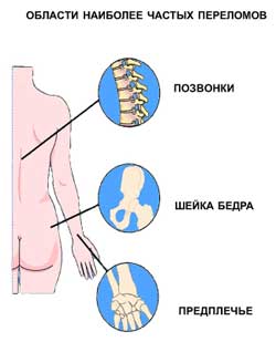 Последствия остеопороза- переломы позвоночника, шейки бедра и