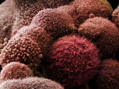 Клетки рака поджелудочной железы. (Фото Dr. Stanley Flegler / Corbis).