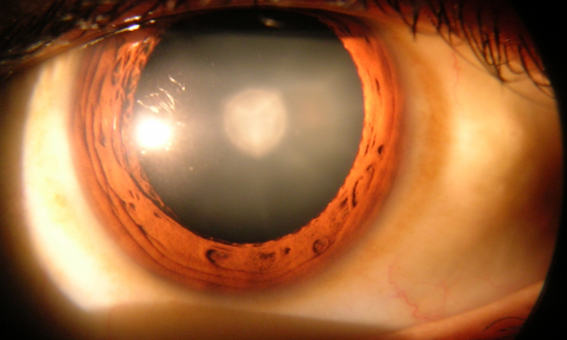Врождённую катаракту вылечили стволовыми клетками 8cf848e44ff785efd3460bfefd6a8b7a