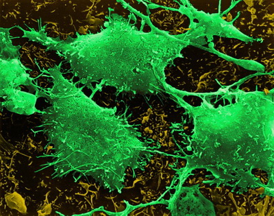 Клетки рака мозга. (Фото Dennis Kunkel Microscopy, Inc. / Visuals Unlimited / Corbis.)