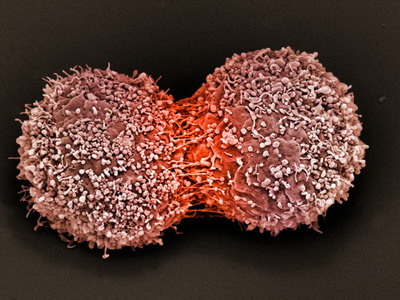 Делящиеся клетки рака молочной железы. (Фото Dr. Stanley Flegler / Visuals Unlimited / Corbis.)