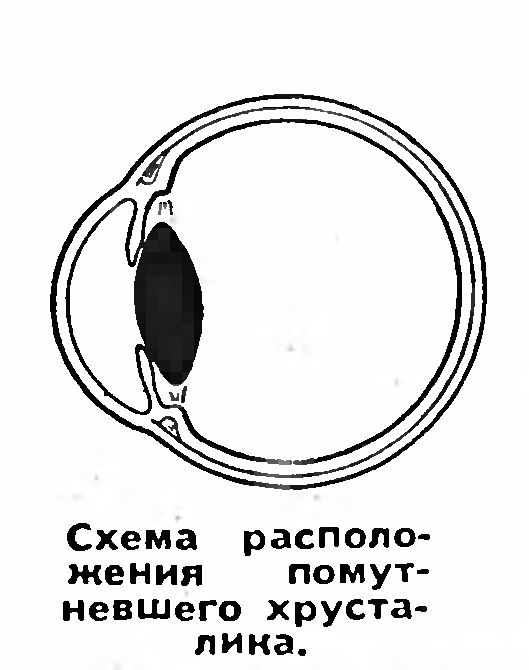 КАПЛИ ИЛИ СКАЛЬПЕЛЬ?