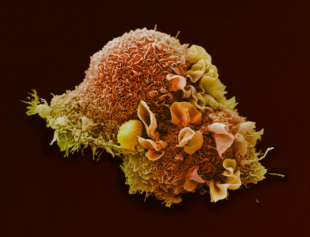 Клетка рака лёгких. (Фото Visuals Unlimited / Corbis.)