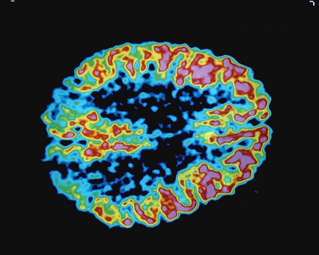 Снимок мозга больного синдромом Альцгеймера, сделанный в позитронно-эмиссионом томографе. (Фото ENERGY.GOV / Flickr.com.)