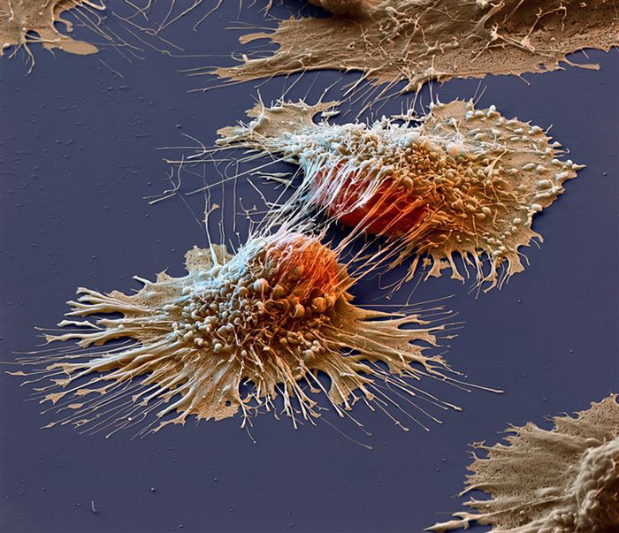 Раковые клетки метастазируют с чужой помощью