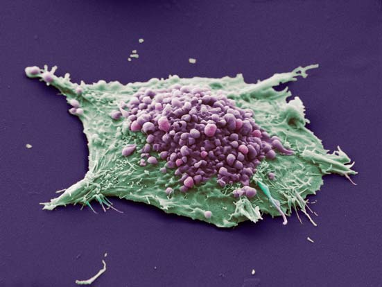 Клетка рака легких. (Фото: Science 3.0 / Flickr.com.)