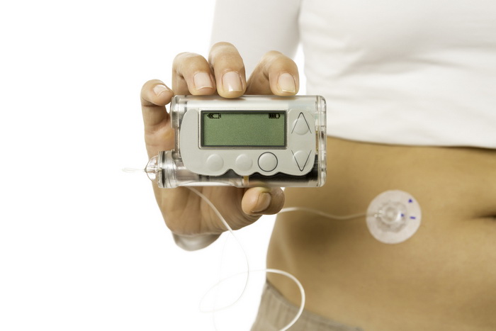 «Электронная поджелудочная» помогает при диабете с осложнениями