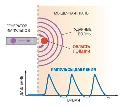 Ударные волны устраняют боль