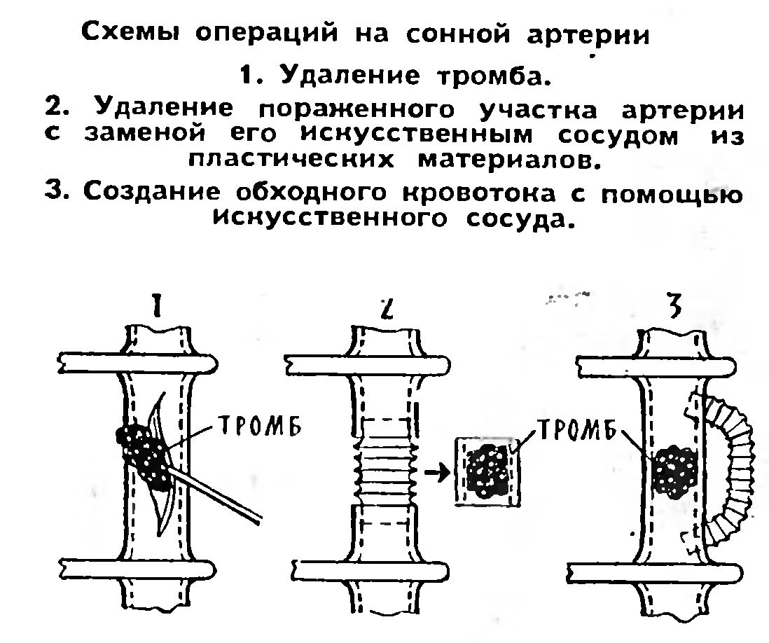 ХИРУРГИ ЛЕЧАТ ИНСУЛЬТ